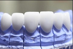 Bọc răng sứ không mài Lavish Hoa Kỳ tại MIAMI - Chất sứ trắng trong tự nhiên