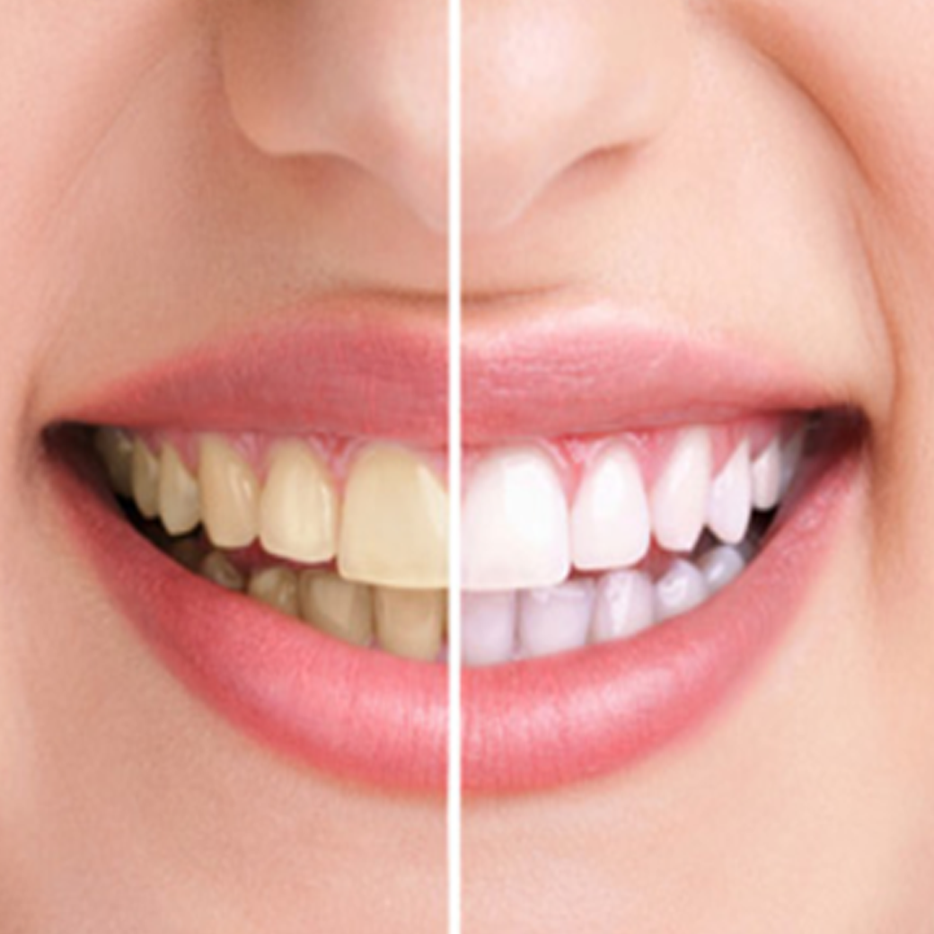Bọc răng sứ Lavish Hoa Kỳ giải quyết tình trạng răng ố vàng làm sao để trắng tại MIAMI